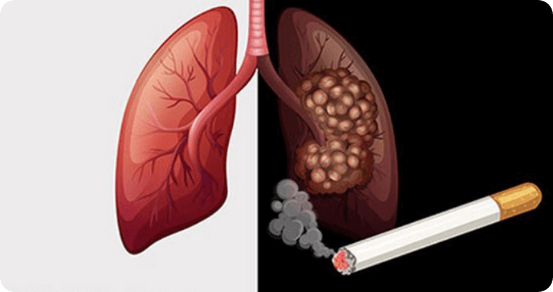 Hút thuốc là gây ung thư phổi Hút thuốc là gây ung thư phổi